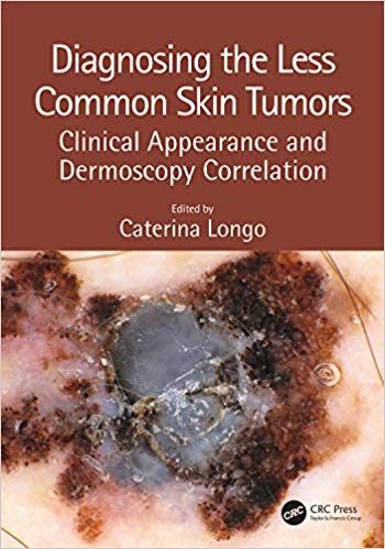 Diagnosing the Less Common Skin Tumors by Caterina Longo 