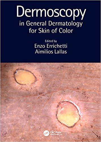Dermoscopy in General Dermatology for Skin of Color by Enzo Errichetti , Aimilios Lallas