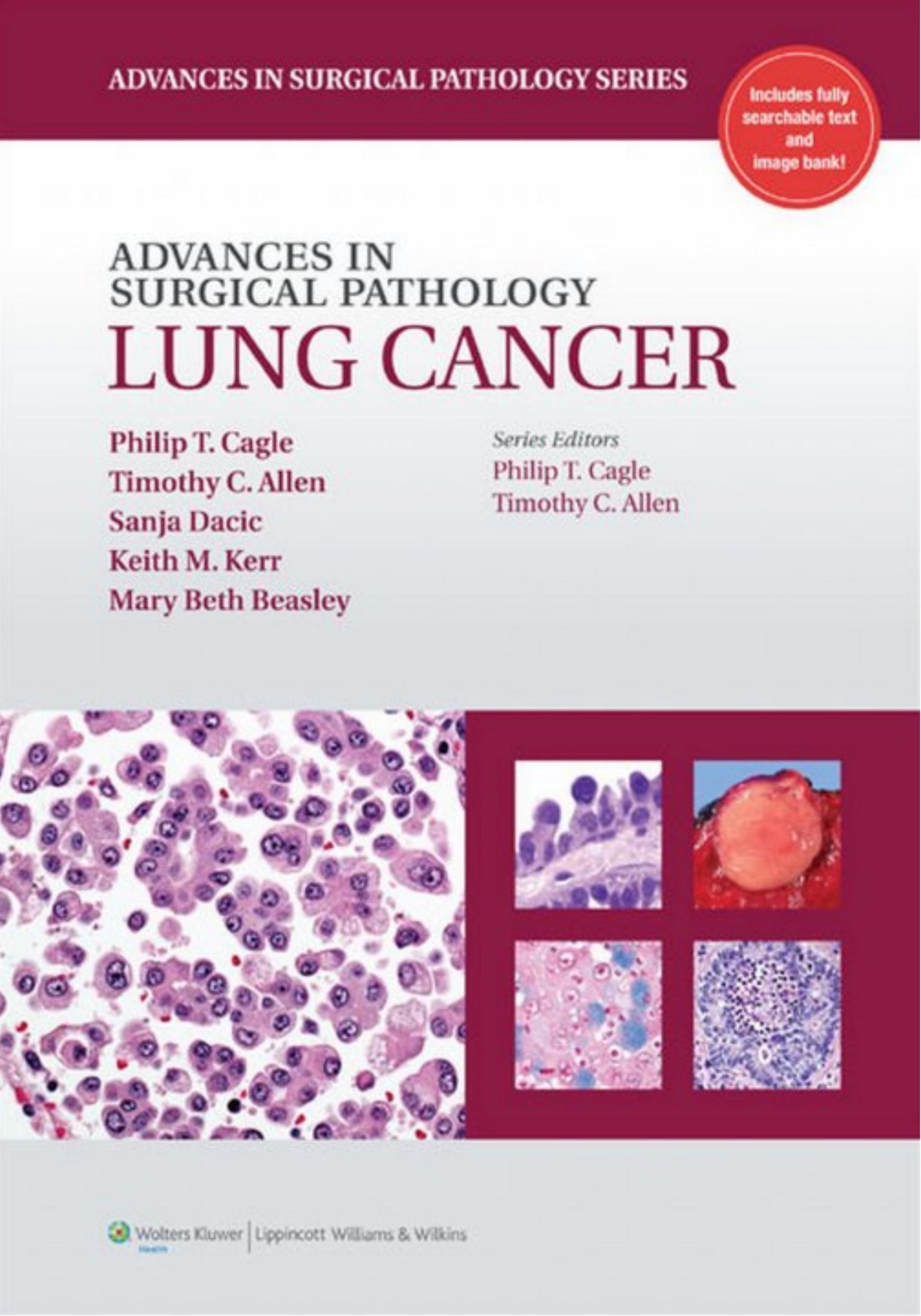 Advances in Surgical Pathology Lung Cancer 1st Edition by Philip T. Cagle , Philip T. Cagle MD , Timothy Allen MD JD 