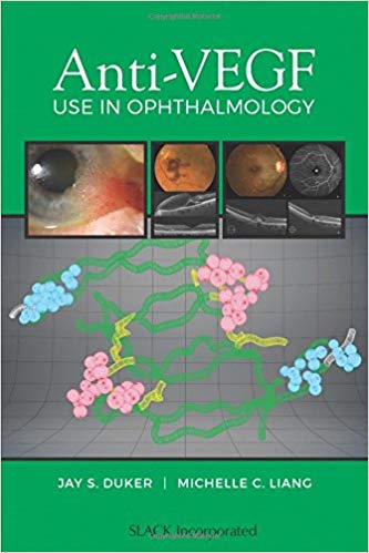 Anti-VEGF Use in Ophthalmology-1 by Jay S Duker MD , Michelle C. Liang MD