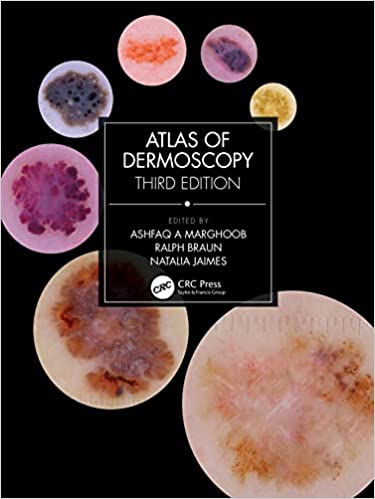 Atlas of Dermoscopy 3rd Edition by Ashfaq A Marghoob , Natalia Jaimes , Ralph Braun 