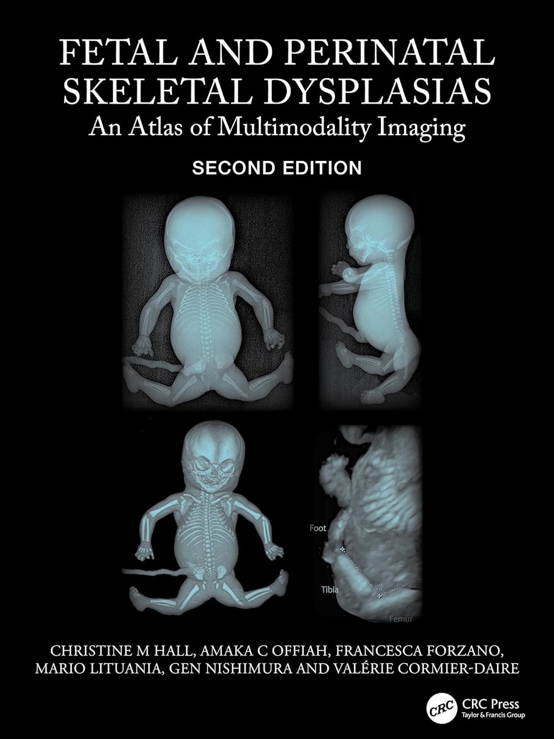 Fetal and Perinatal Skeletal Dysplasias: An Atlas of Multimodality Imaging 2e  by Christine M Hall 